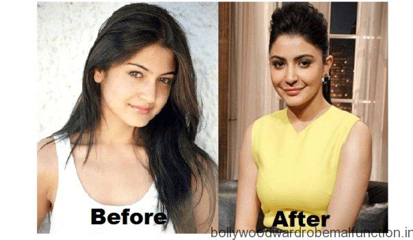 Anushka Sharma Anushka Sharma Plastic Surgery
