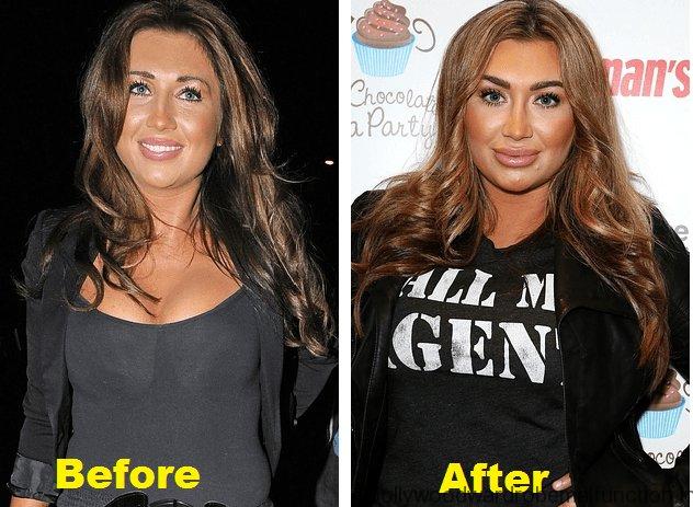 Lauren Goodger Plastic Surgery
