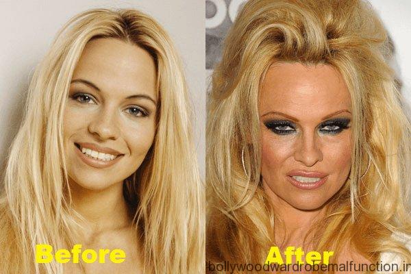 Pamela Anderson Pamela Anderson Plastic Surgery