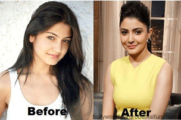 Anushka Sharma Plastic Surgery